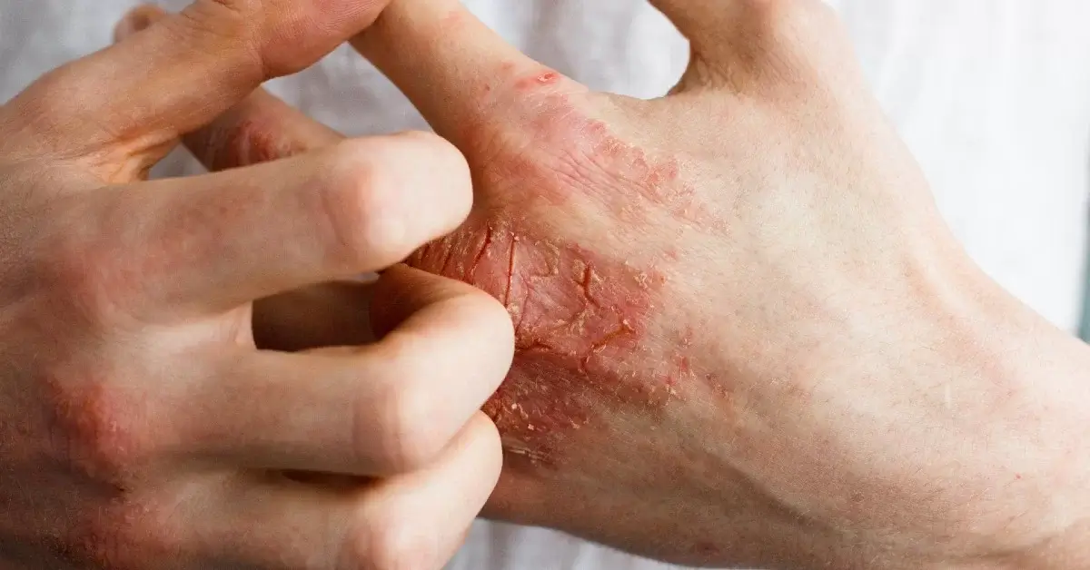 Eczemă pe mâini