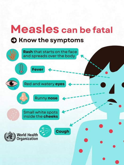 OMS: Semnele rujeolei și când să solicitați asistență medicală